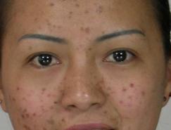 PS画笔去除人物脸上的痘点